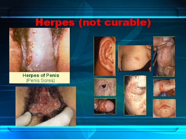 Herpes (not curable) 