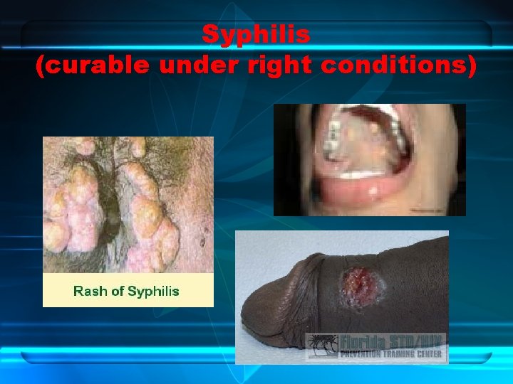 Syphilis (curable under right conditions) 