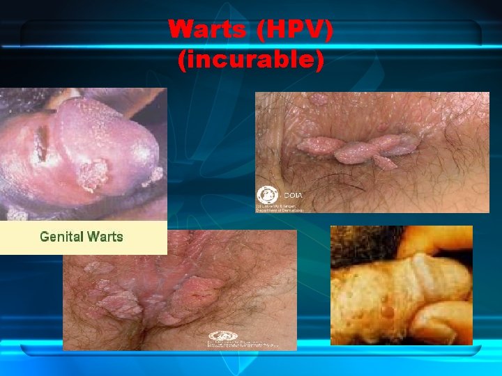 Warts (HPV) (incurable) 