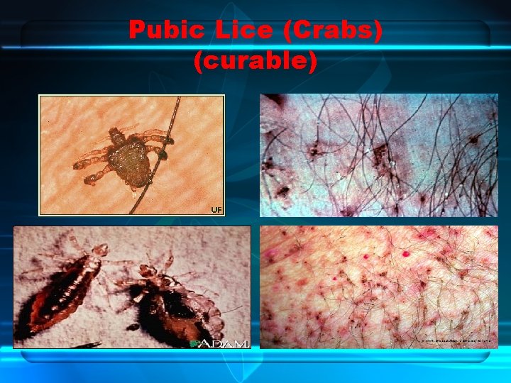 Pubic Lice (Crabs) (curable) 