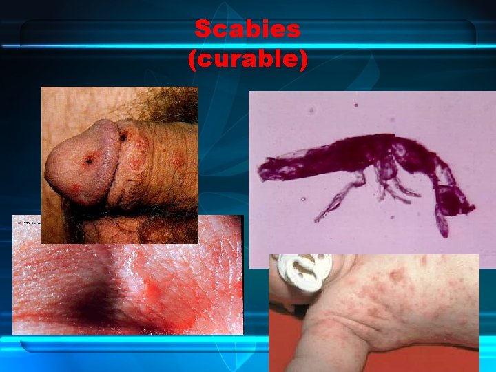 Scabies (curable) 