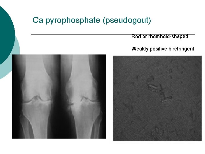 Ca pyrophosphate (pseudogout) Rod or rhomboid-shaped Weakly positive birefringent 