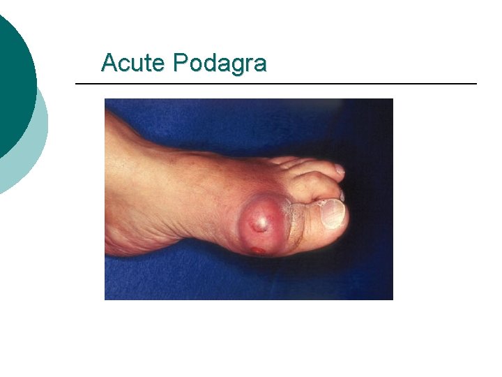 Acute Podagra 