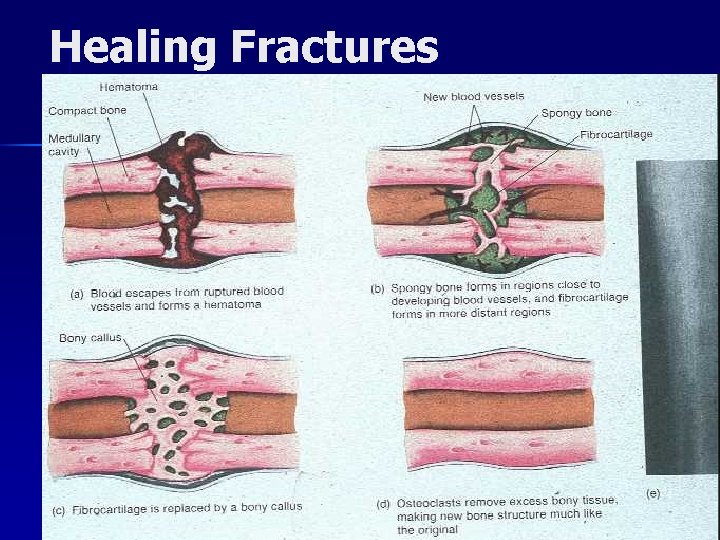 Healing Fractures 