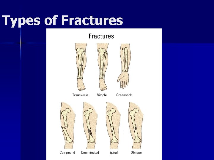 Types of Fractures 
