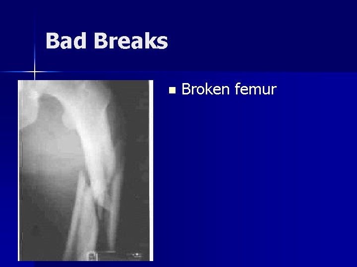 Bad Breaks n Broken femur 