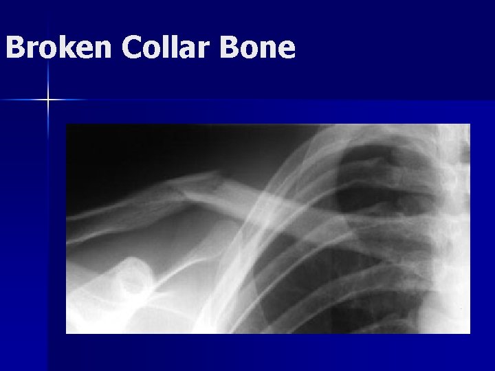 Broken Collar Bone 