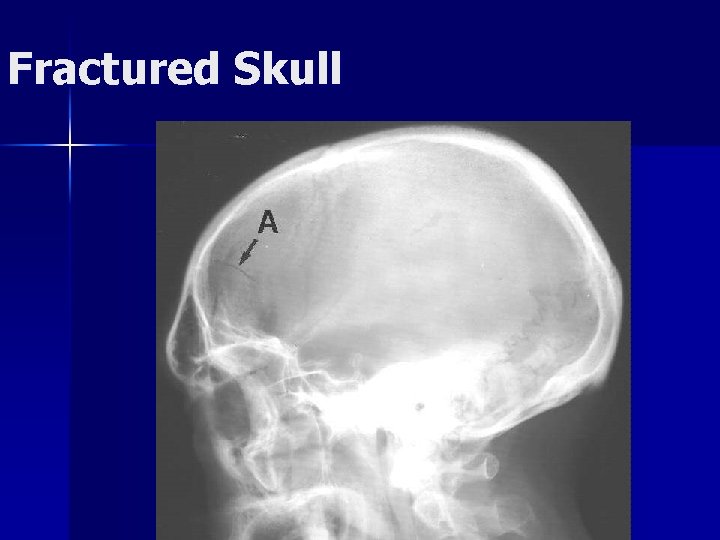 Fractured Skull 