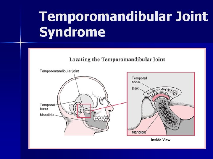Temporomandibular Joint Syndrome 