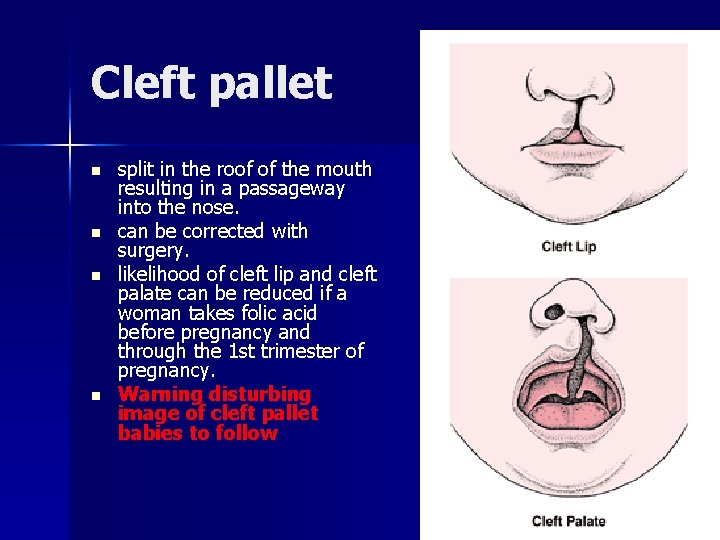 Cleft pallet n n split in the roof of the mouth resulting in a