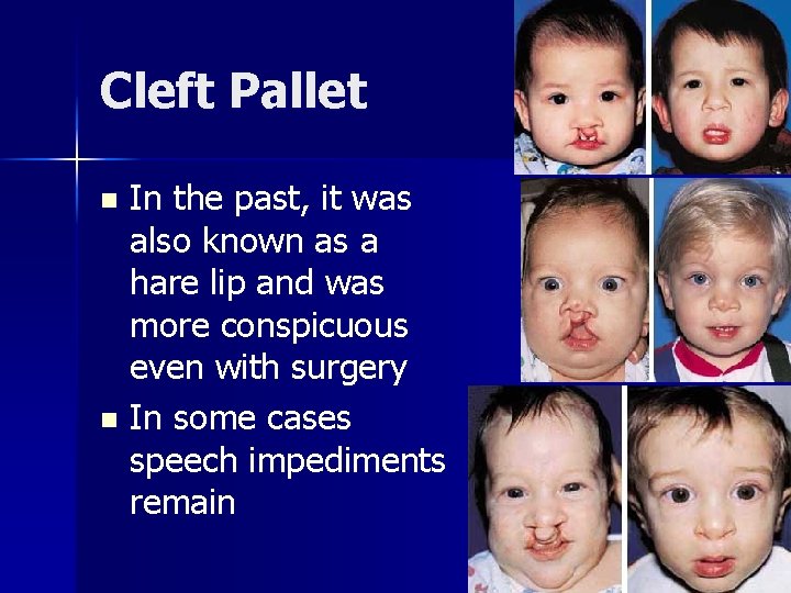 Cleft Pallet In the past, it was also known as a hare lip and