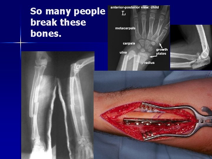 So many people break these bones. 