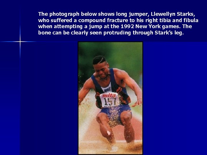 The photograph below shows long jumper, Llewellyn Starks, who suffered a compound fracture to