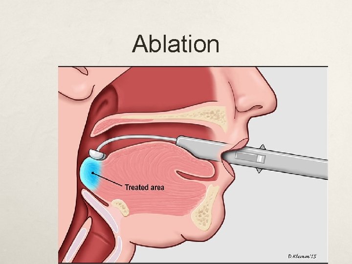 Ablation 