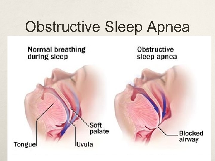 Obstructive Sleep Apnea 