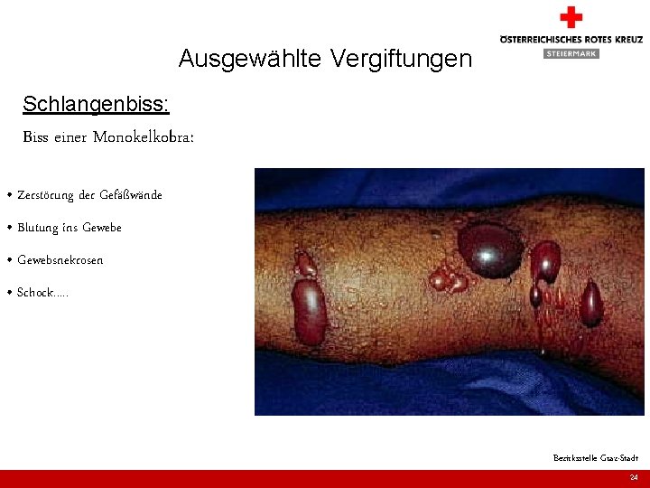 Ausgewählte Vergiftungen Schlangenbiss: Biss einer Monokelkobra: • Zerstörung der Gefäßwände • Blutung ins Gewebe