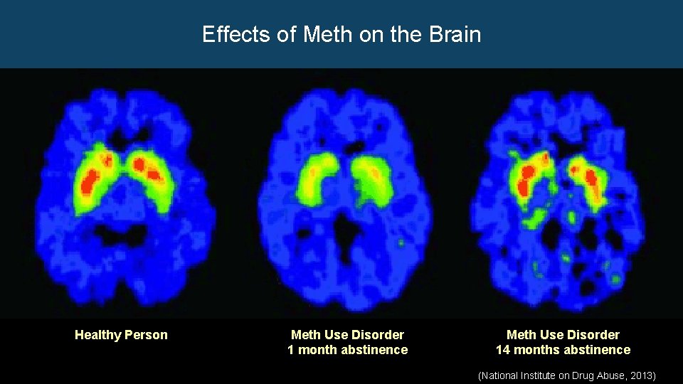 Effects of Meth on the Brain Healthy Person (National Institute on Drug Abuse, 2013)