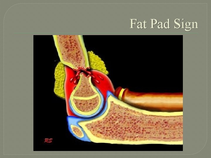 Fat Pad Sign 