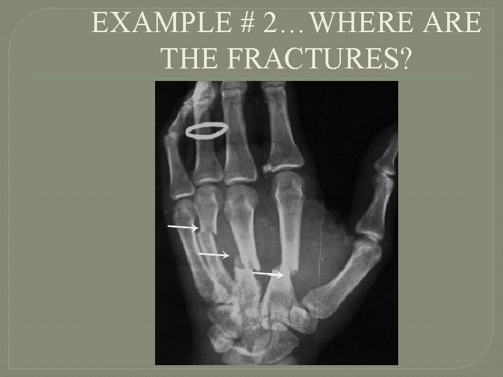 EXAMPLE # 2…WHERE ARE THE FRACTURES? 