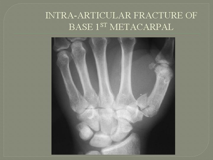 INTRA-ARTICULAR FRACTURE OF BASE 1 ST METACARPAL 