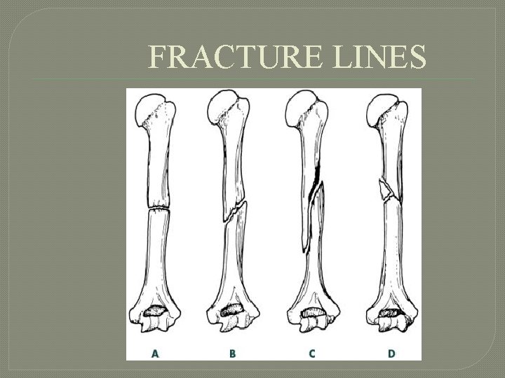 FRACTURE LINES 