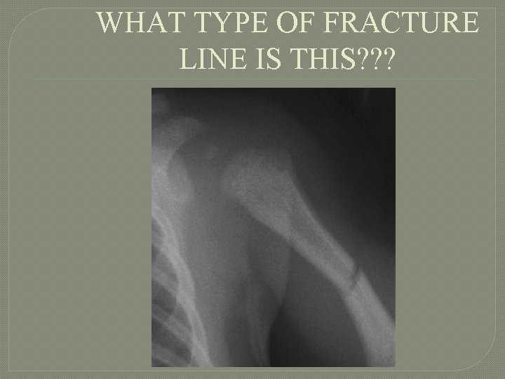 WHAT TYPE OF FRACTURE LINE IS THIS? ? ? 