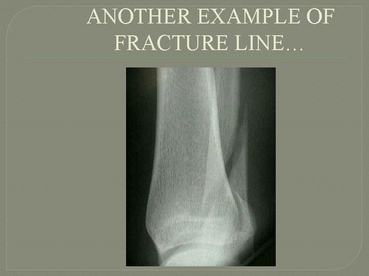 ANOTHER EXAMPLE OF FRACTURE LINE… 