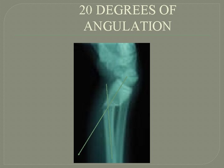 20 DEGREES OF ANGULATION 