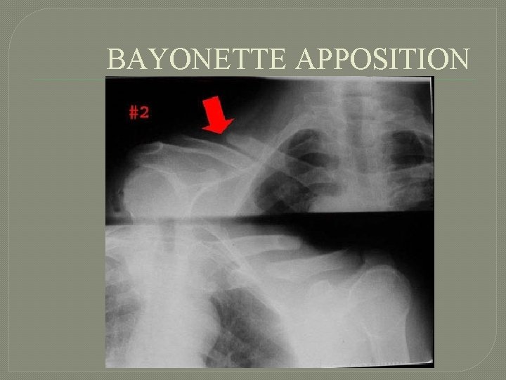 BAYONETTE APPOSITION 