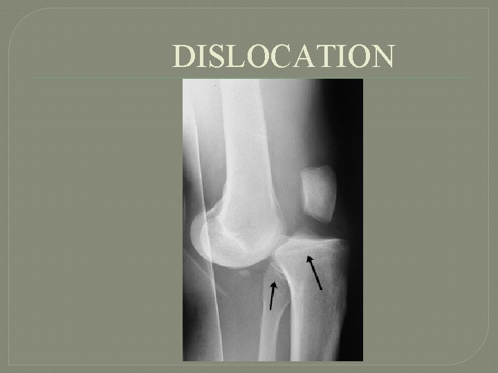 DISLOCATION 