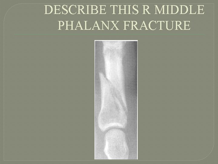 DESCRIBE THIS R MIDDLE PHALANX FRACTURE 