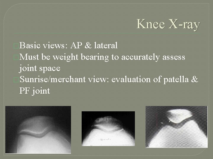 Knee X-ray �Basic views: AP & lateral �Must be weight bearing to accurately assess