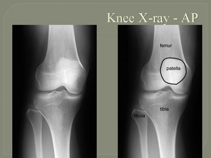 Knee X-ray - AP 