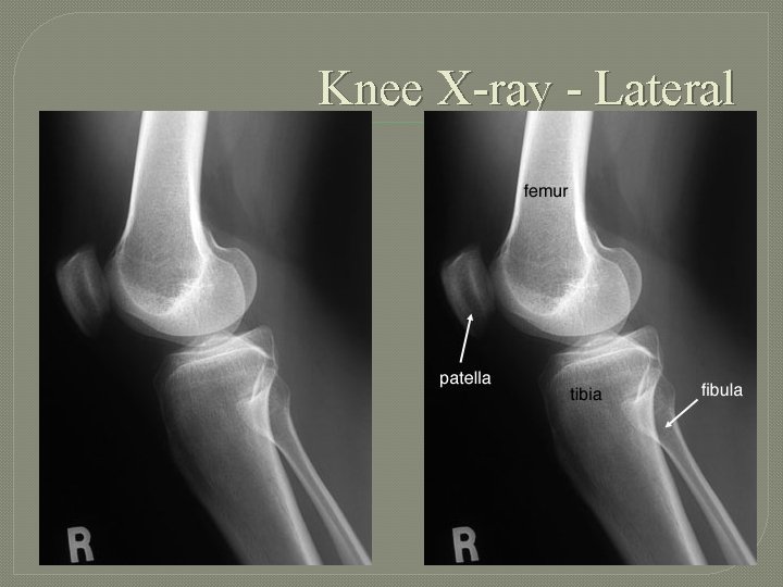 Knee X-ray - Lateral 