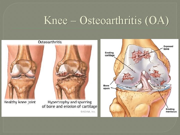 Knee – Osteoarthritis (OA) 