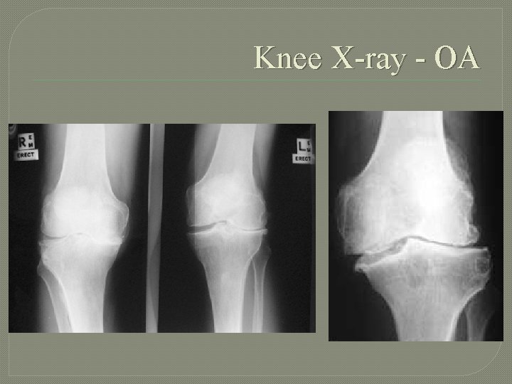 Knee X-ray - OA 
