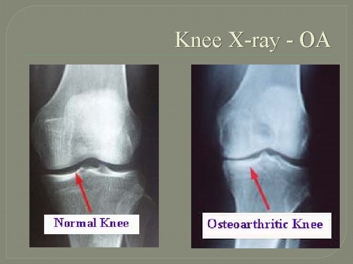 Knee X-ray - OA 