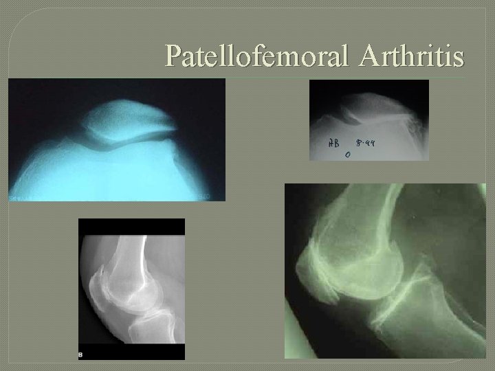 Patellofemoral Arthritis 