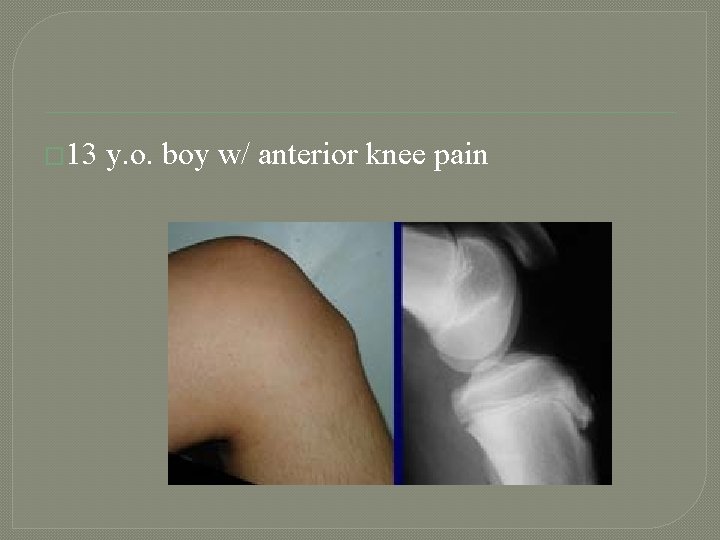 � 13 y. o. boy w/ anterior knee pain 