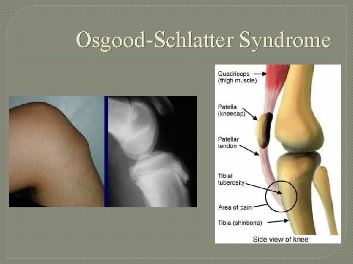 Osgood-Schlatter Syndrome 