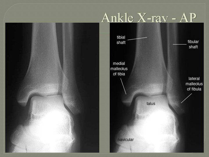 Ankle X-ray - AP 