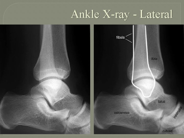 Ankle X-ray - Lateral 