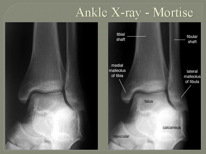 Ankle X-ray - Mortise 