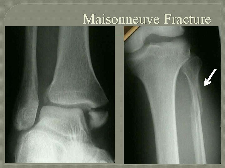 Maisonneuve Fracture 