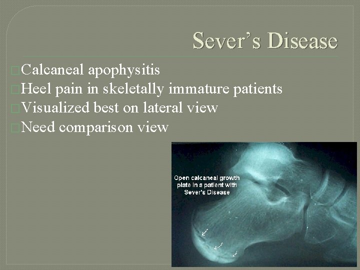 Sever’s Disease �Calcaneal apophysitis �Heel pain in skeletally immature patients �Visualized best on lateral