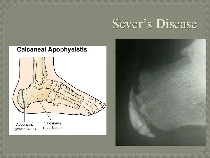 Sever’s Disease 