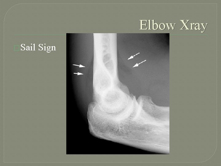 Elbow Xray �Sail Sign 