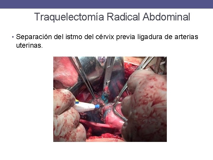 Traquelectomía Radical Abdominal • Separación del istmo del cérvix previa ligadura de arterias uterinas.