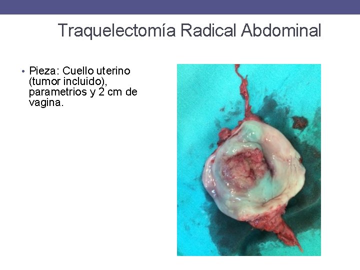 Traquelectomía Radical Abdominal • Pieza: Cuello uterino (tumor incluido), parametrios y 2 cm de