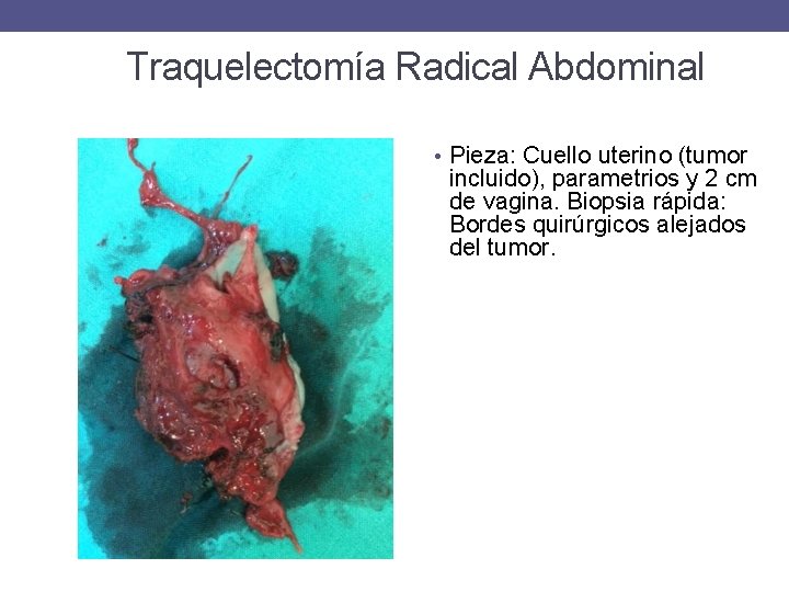 Traquelectomía Radical Abdominal • Pieza: Cuello uterino (tumor incluido), parametrios y 2 cm de